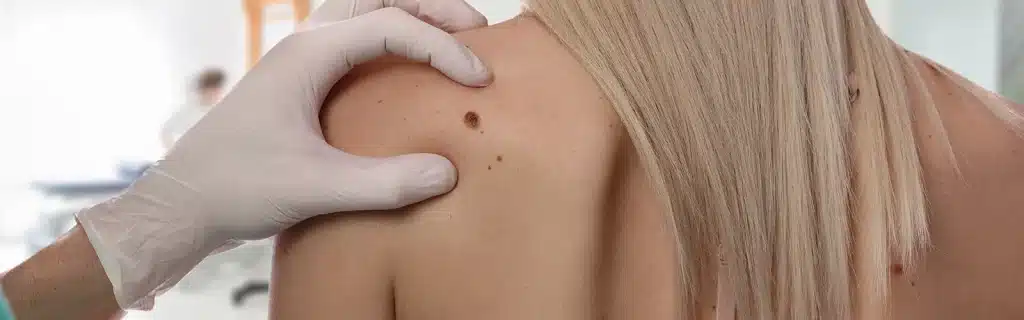 A gloved hand inspecting a mole on the back of a woman